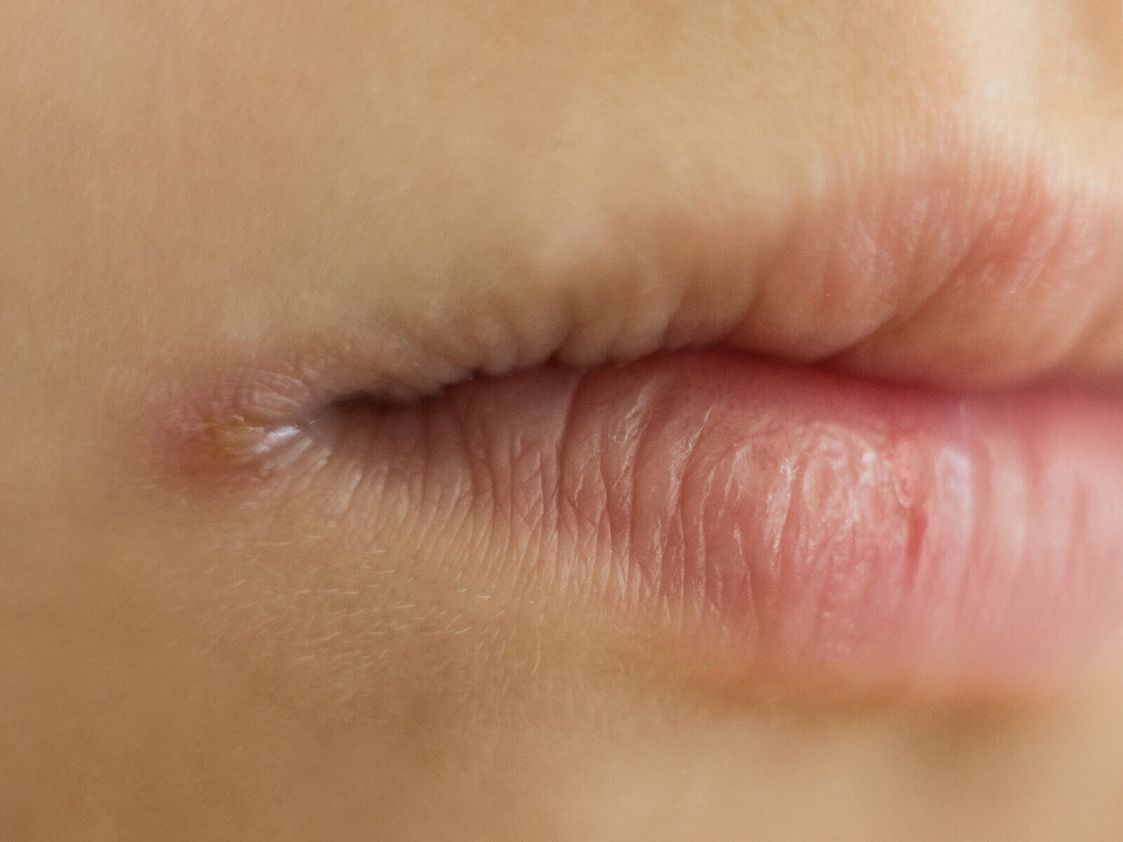 What foods cause angular cheilitis?