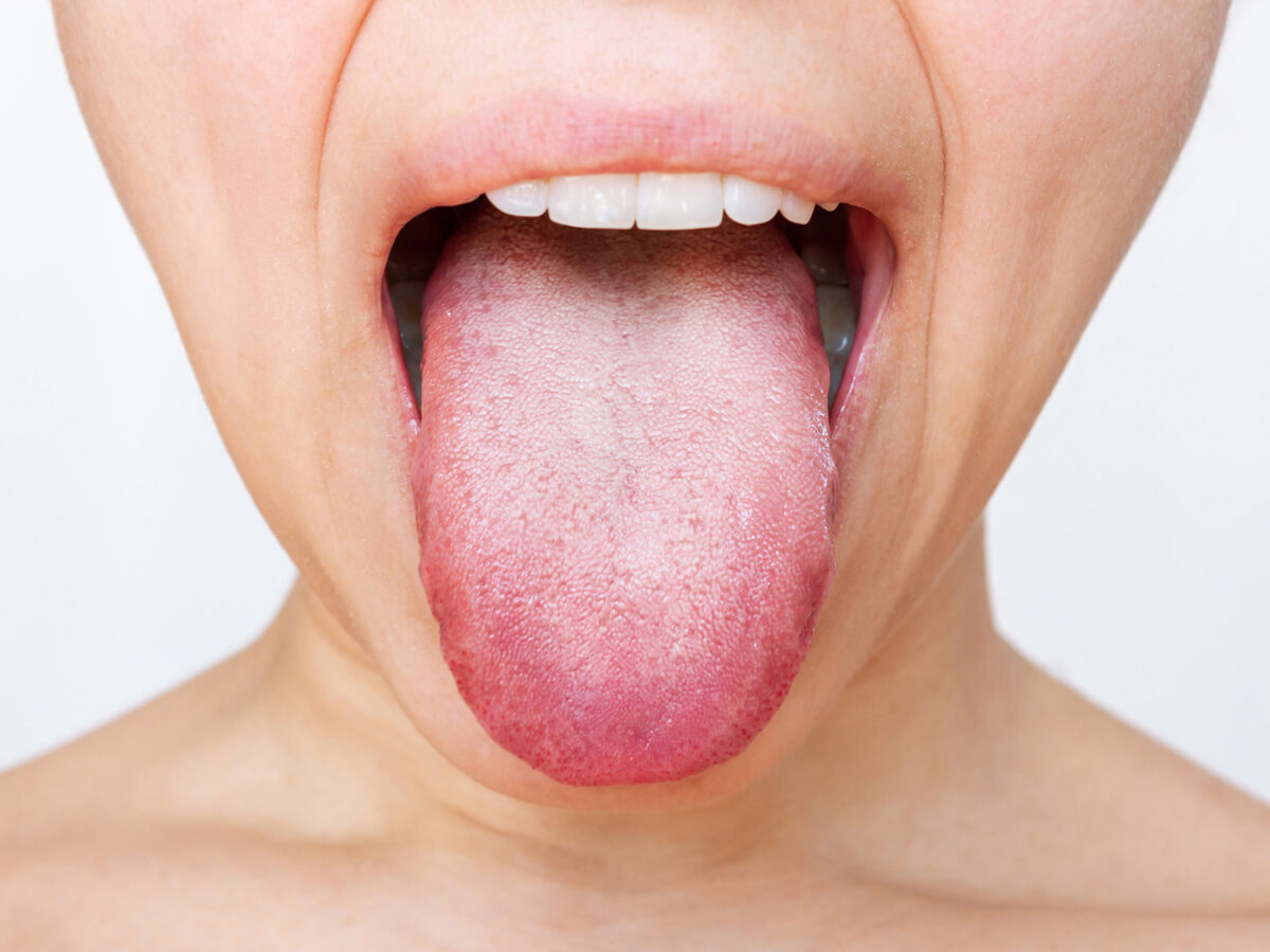 What Are The Main Causes of White Tongue?