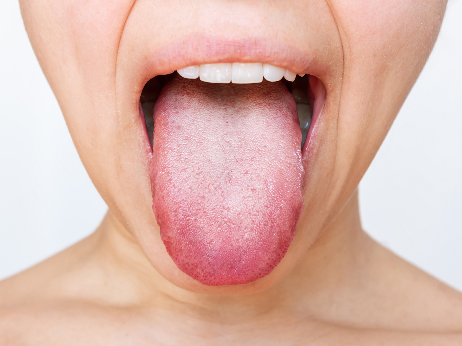 What Are The Main Causes of White Tongue?
