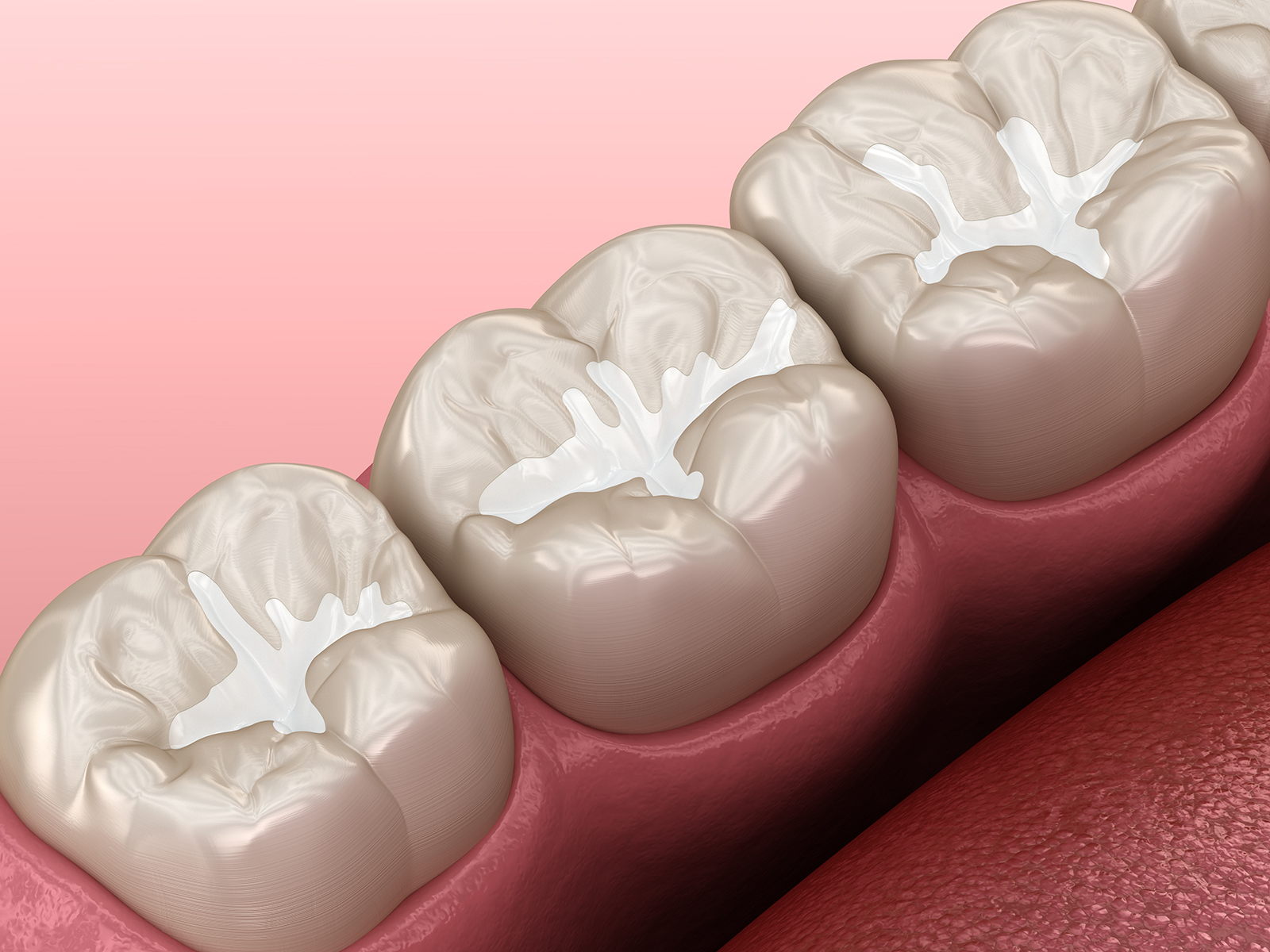 Who Is A Good Candidate For Dental Sealants?