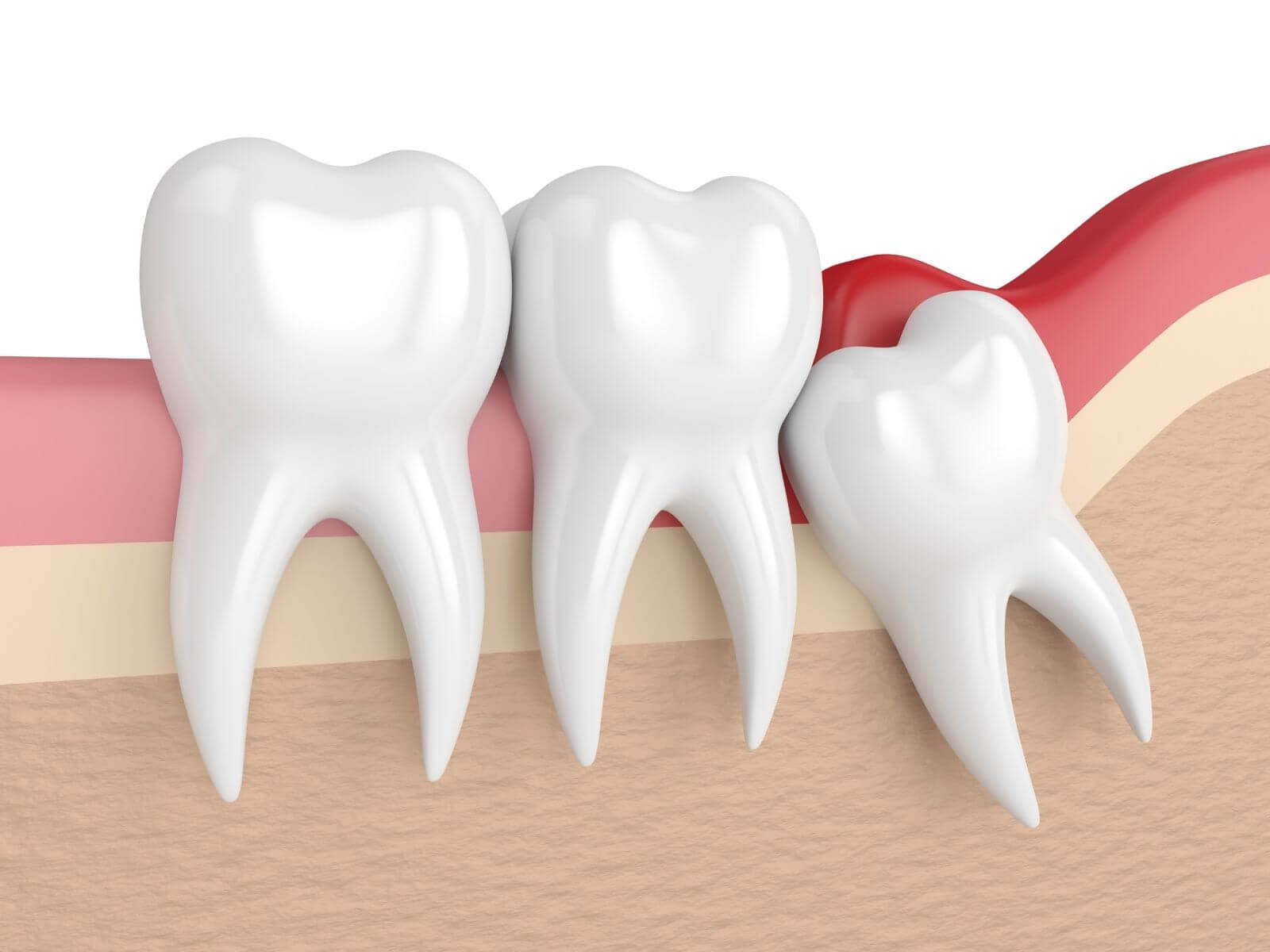 Wisdom Teeth Removal: What You Need To Know