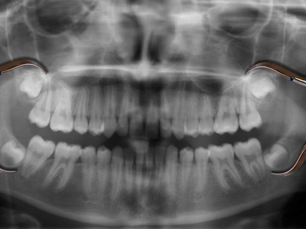 Do You Really Need Dental X-Rays Every Year?