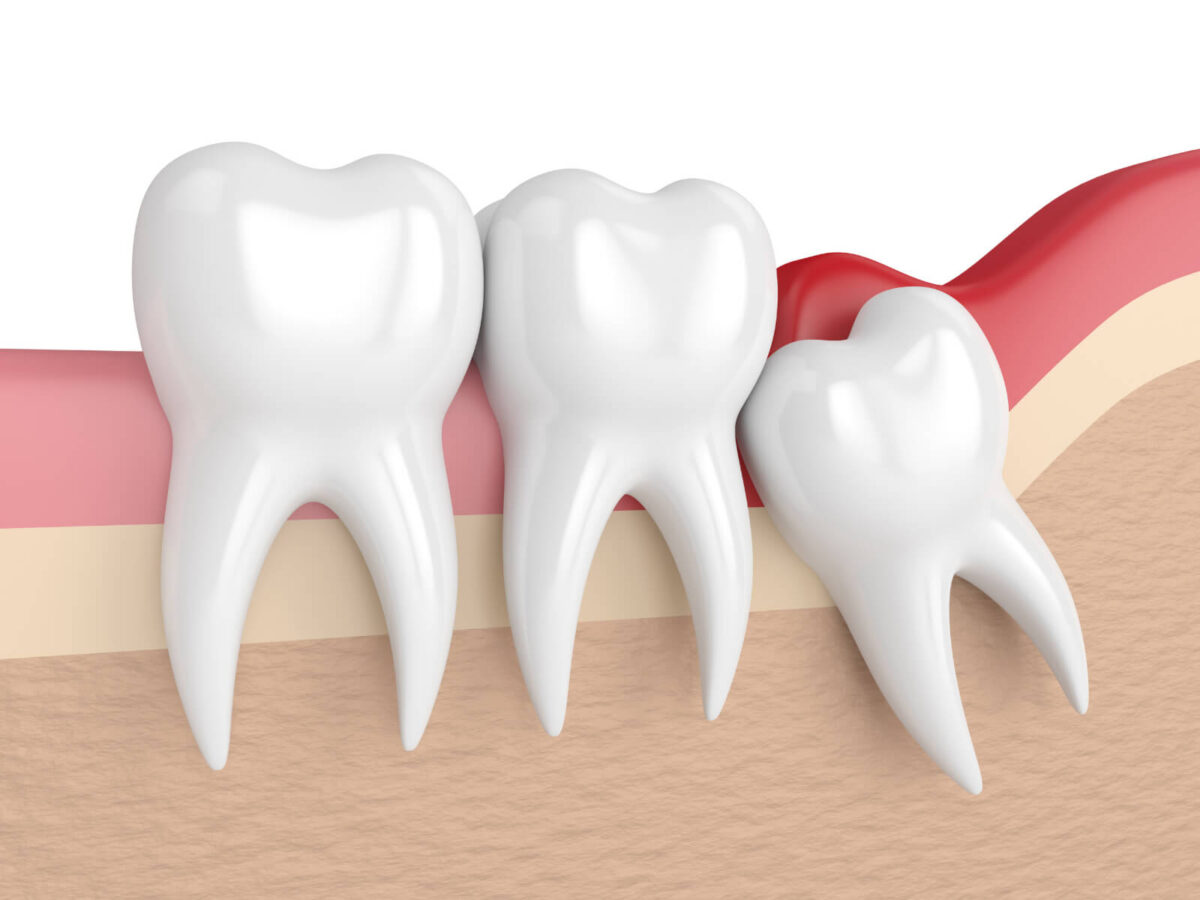 Pain Management After Wisdom Teeth Removal: Tips For A Smooth Recovery