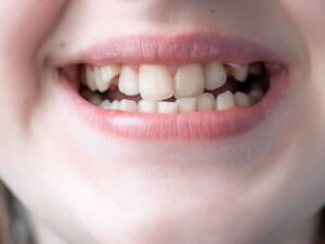 7 Common Reasons Why Teeth Become Crooked Over Time