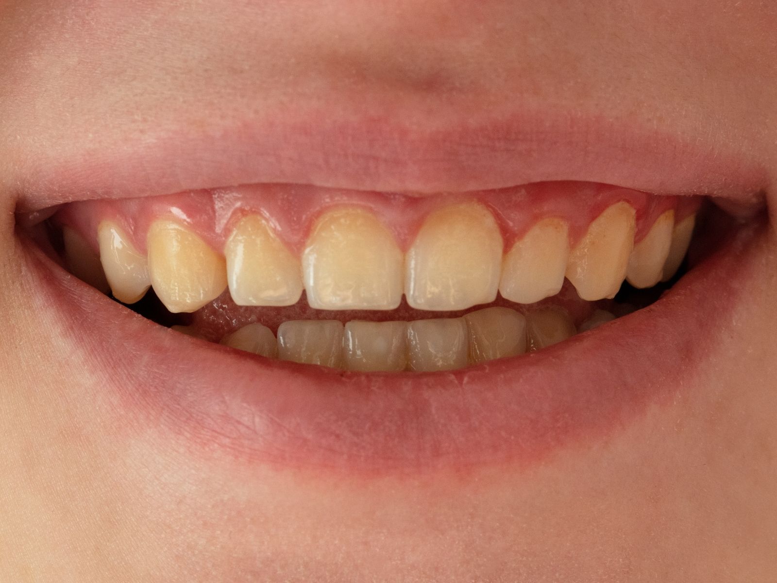 How to Get Rid of Yellow Teeth: Safe and Effective Methods