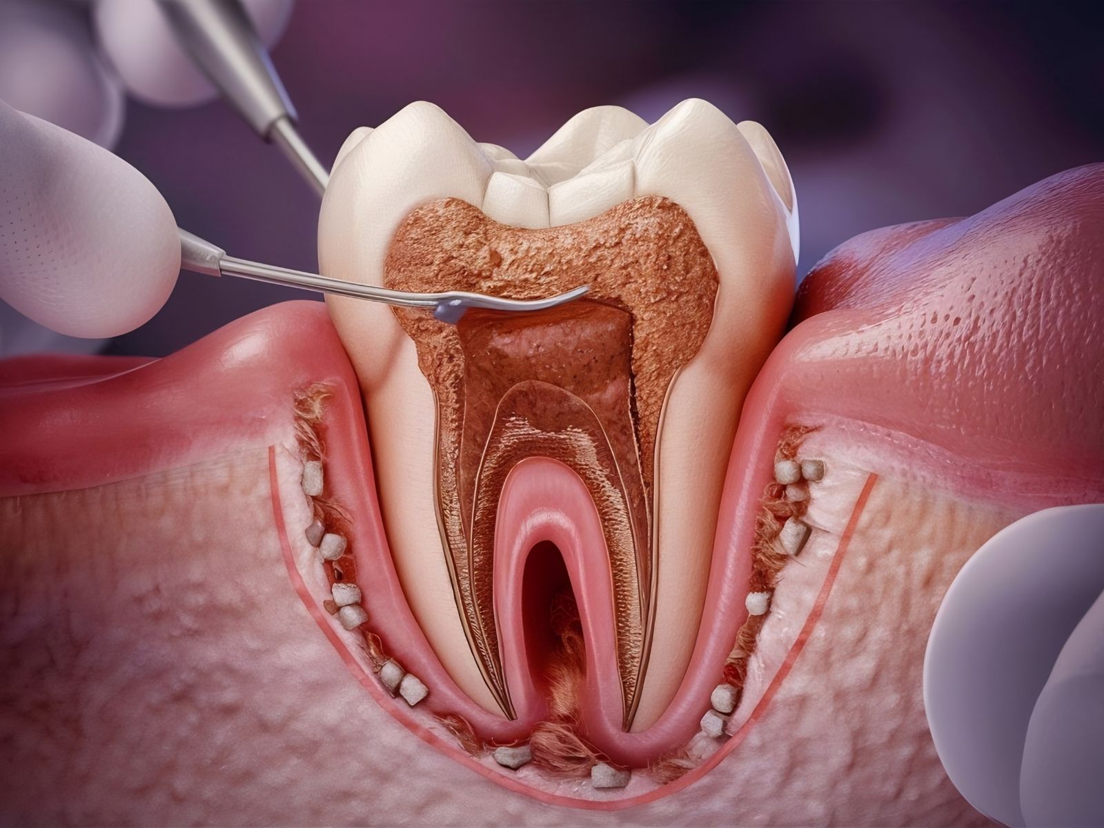 The 5 Stages of Tooth Decay: What Happens and How Each Is Treated