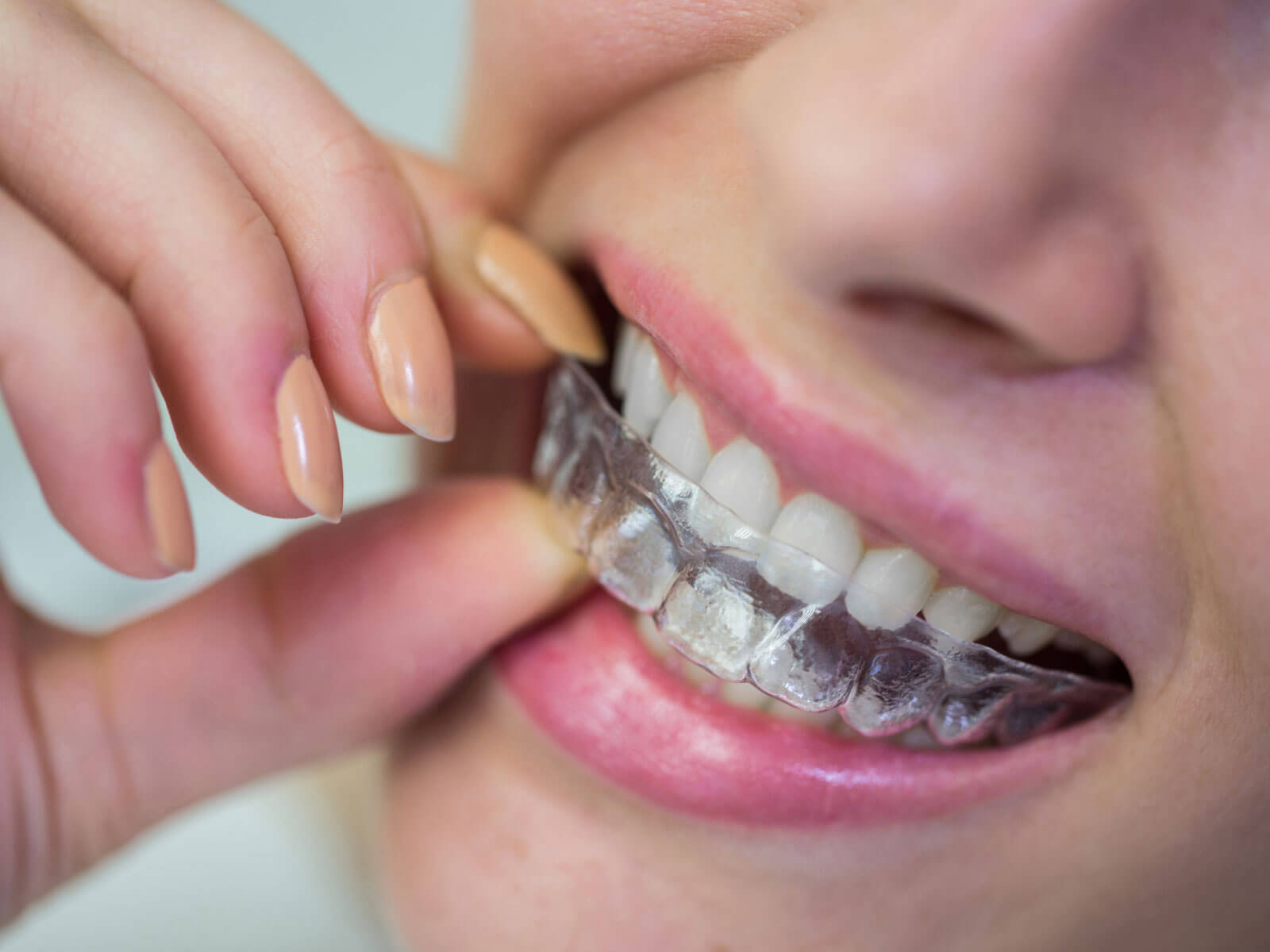 How Much Does Invisalign Cost in 2026? Average Price, Insurance Coverage & Payment Plans