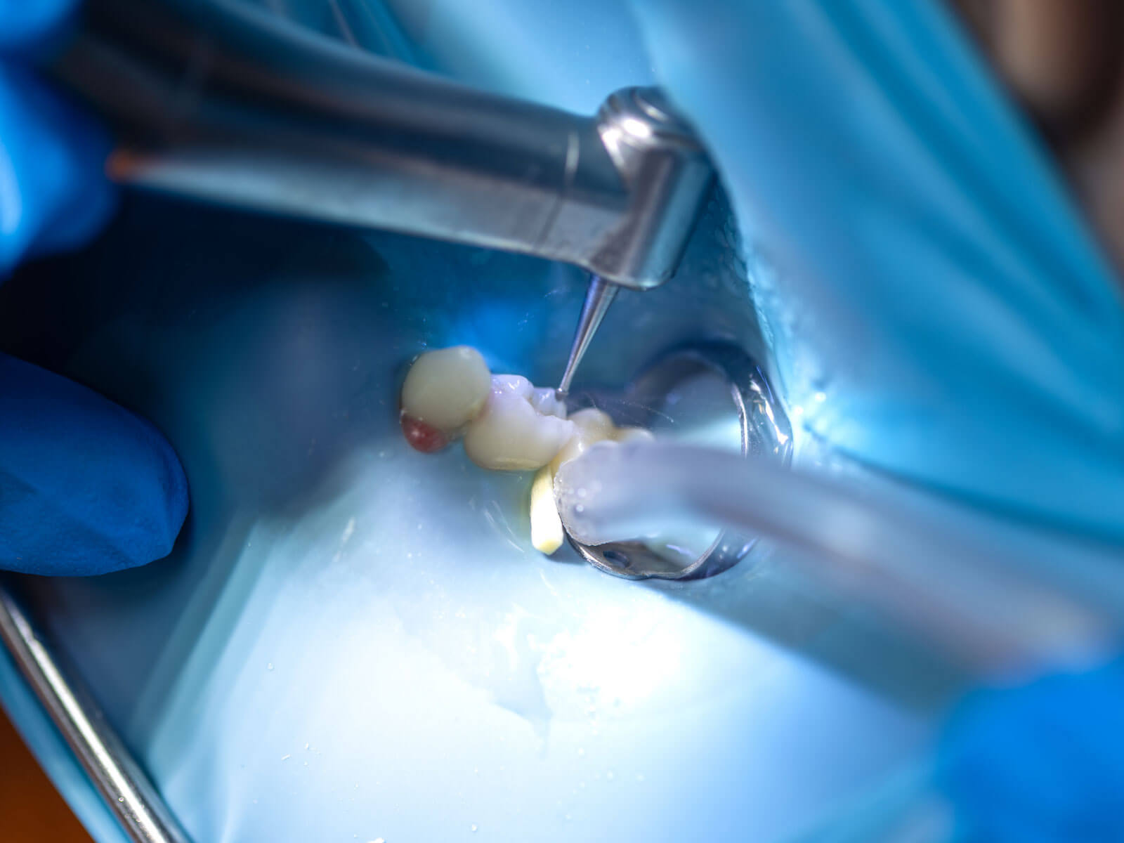 Root Canal vs. Tooth Extraction: Which Is Better? Cost, Pain, Recovery & Long-Term Outcomes